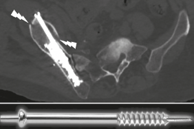 Ostéosynthèse cimentée percutanée en oncologie