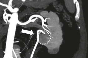 Ablation d’une tumeur centrale du rein : comment je fais ?