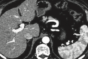 Lipiodol marqué au rhénium 188 : agent d’avenir pour la radioembolisation