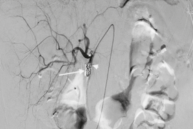 Pose de cathéter intra-artériel hépatique implanté