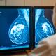 Essai monarchE et cancers du sein HR+, HER2-, à haut risque de récidive