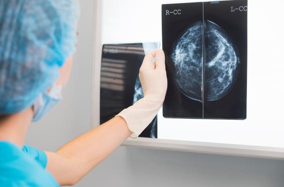 Prise en charge axillaire dans les cancers du sein de stade précoce