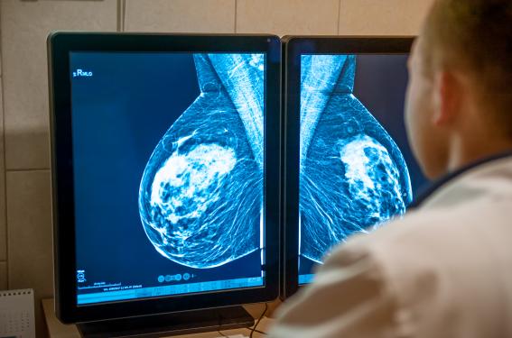 Essai monarchE et cancers du sein HR+, HER2-, à haut risque de récidive