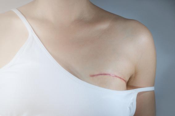La mastectomie bilatérale