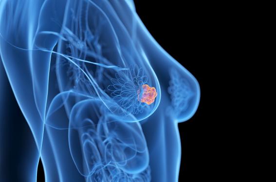 Essai I-SPY 2 et cancers du sein HER2- de haut risque