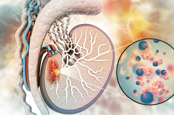 ASCO GU 2023 - Cancer du testicule : nouvelle classification ...