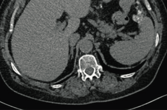 Cancers séreux de bas grade : implications chirurgicales ...